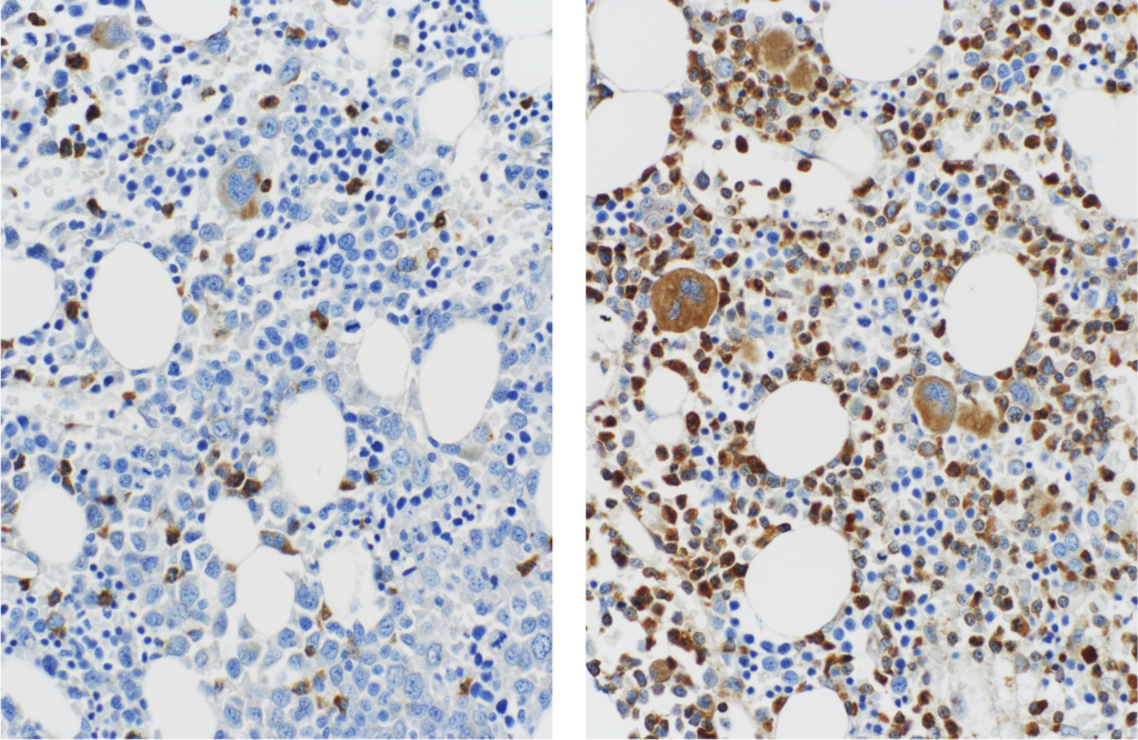 A microscope image of cells before and after a bone marrow transplant